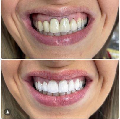 Before and after of our veneers.