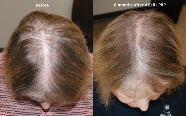 Before and After Scalp Injections