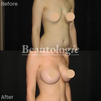 Bilateral Breast Augmentation with 475ml Right and 460ml Left Saline Implants Before and After