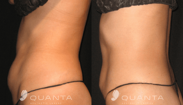 Abdomen results after 5 VASERShape Treatments