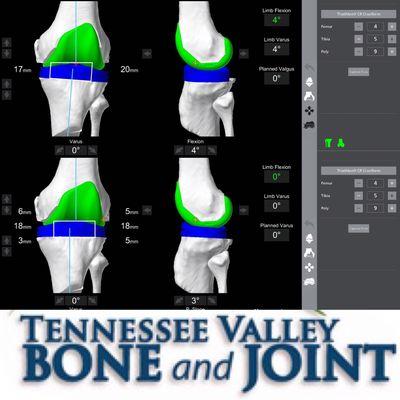 I love using the Stryker MAKO robotic assisted technology to create custom partial and total knee replacements!