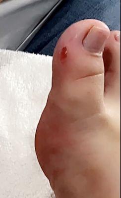 Injury during pedicure