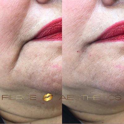 Dermal Filler