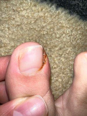 Day 1 cut/ infected toe