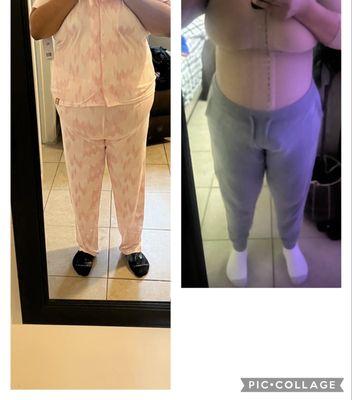 I got a tummy tuck, lipo 360 and bbl