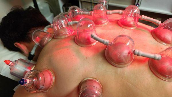 Cupping Therapy