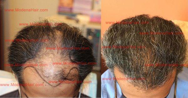 Before & After Hair Transplant Surgery + PRP with ACell