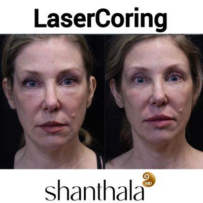 The most innovative LASERCORING with Ultraclear by Dr. Shanthala