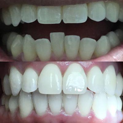 Whitening & Invisalign treatment by Dr. Minh