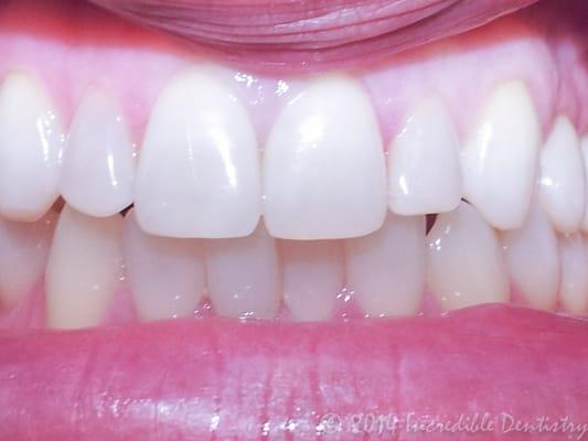 simple composite filling on #10 after gum therapy