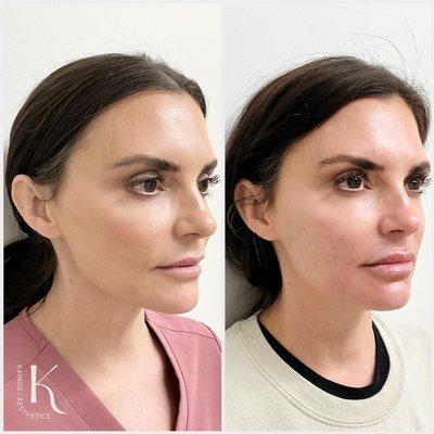 Full face rejuvenation focusing on cheeks, chin shadowing, lips and fine lines around the mouth.