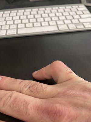 How my finger looks on 3.25.2024.