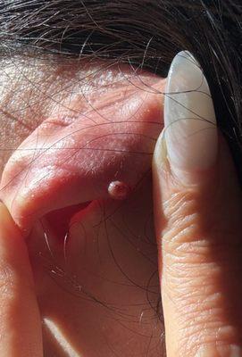 Right Ear Keloid infection