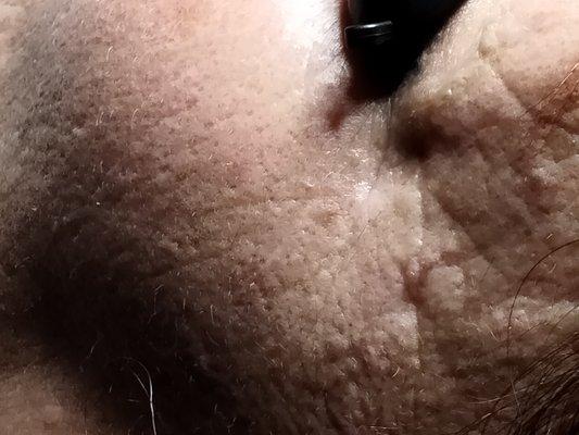 Age Defense Treatment After   (Removed black heads and skin is visibly smoother with less wrinkles)