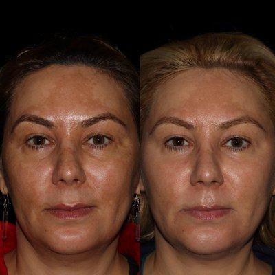 Cosmelan to help reduce Melasma