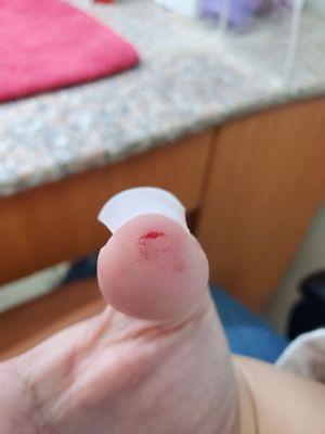 A chunk of my thumb was cut!