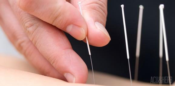 Needles used in the acupuncture sessions are thinner than a strand of hair