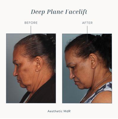 Deep Plane Facelift by: Dr.Luis Macias