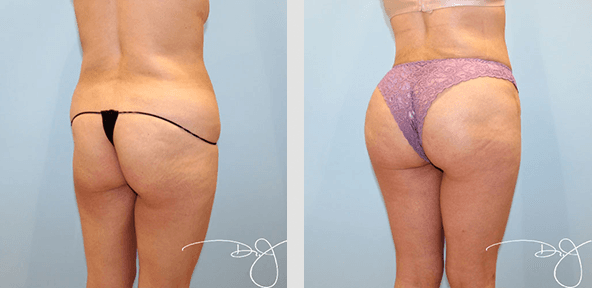 Natural Butt Lift® (LipoContouring + Fat Transfer to buttock)