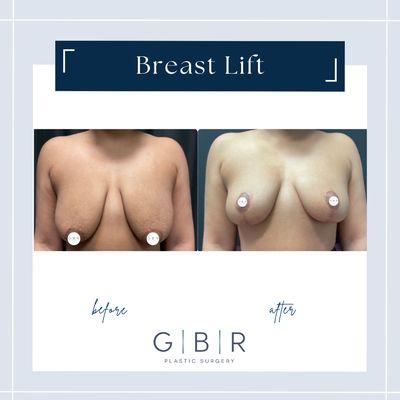 Mastopexy "breast lift"