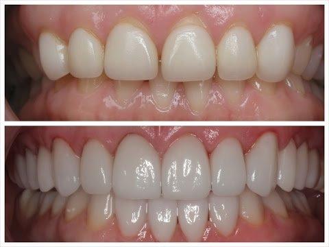 Porcelain Veneers