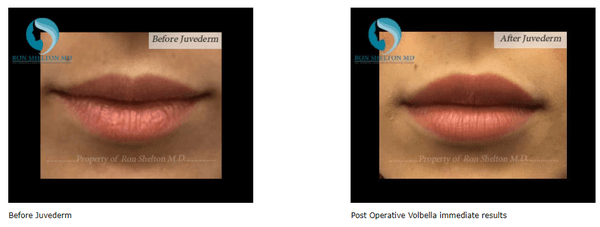 Dermal fillers before and after