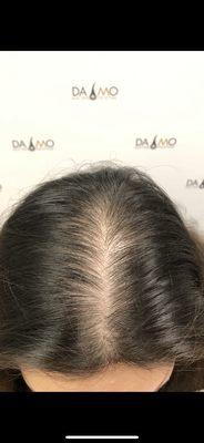 Damo Hair Loss Solution