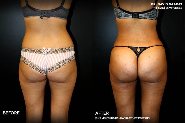 Beverly Hills Butt Lift  Procedure done @ Beverly Hills Aesthetic Surgical Institute by Dr. D. David Saadat MD