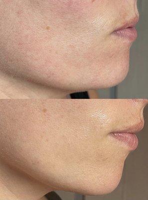 Geneo Facial with Kess.  Beautiful results with one treatment!  Skin is lifted, reduced redness, brighter and hydrated.