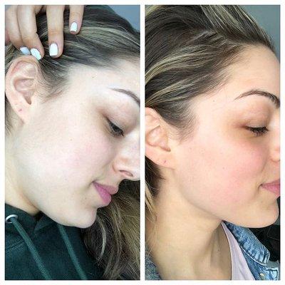 Dermaplaning before and after.