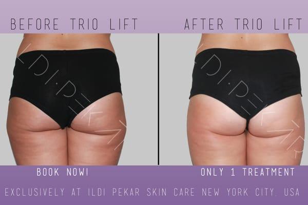 Before and After 1 session from our Trio Lift - Radio Frequency Service. Shrinks fat and tightens skin.