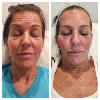 IPL Photofacial and PRP undereye injections