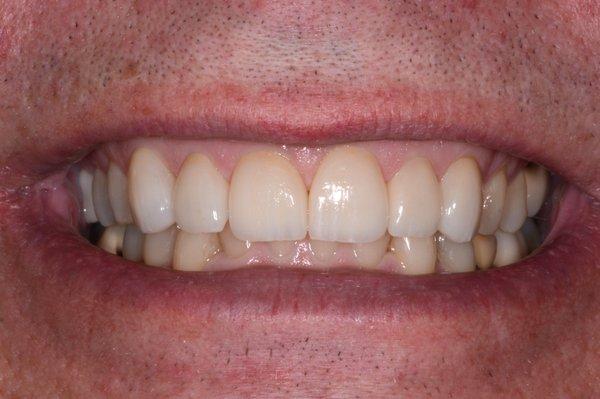 New Veneers!