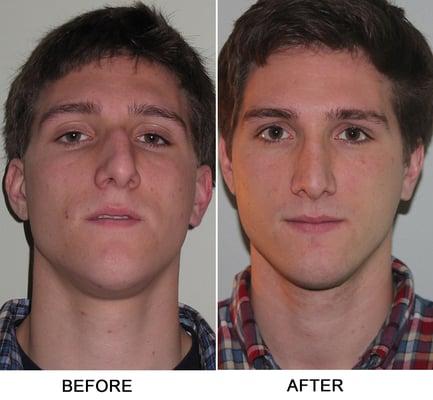 Deviated Septum Surgery