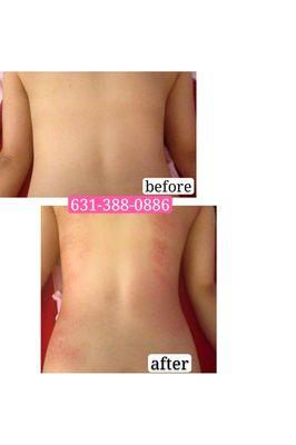 She only did one session to slim her back, You already can see the result. No pain, no itch. Easy and fast to loss weight.