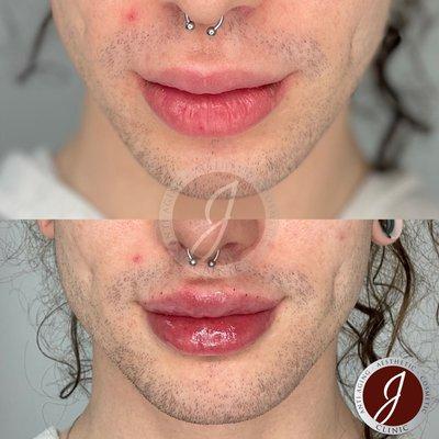 Juvederm lip fillers