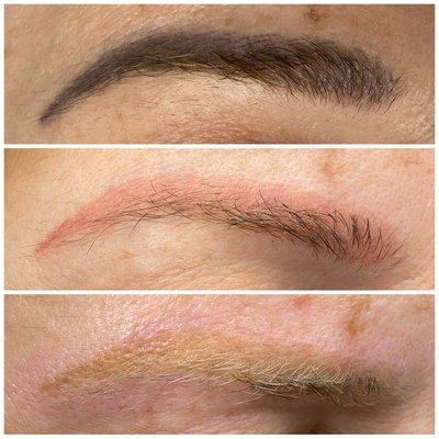 2 procedures of laser permanent make up removal.