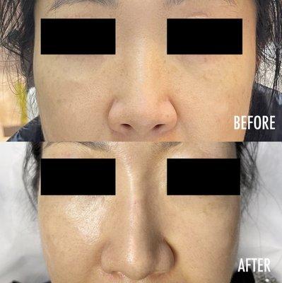 Nose filler done the right way! Time to pursue the results you want! Here at Esprit we help with quick, simple and safe filler procedures!