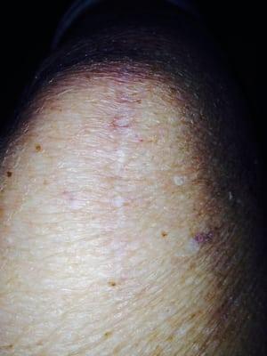 This is my left knee from last year.