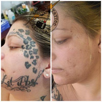 Reno Tattoo Removal