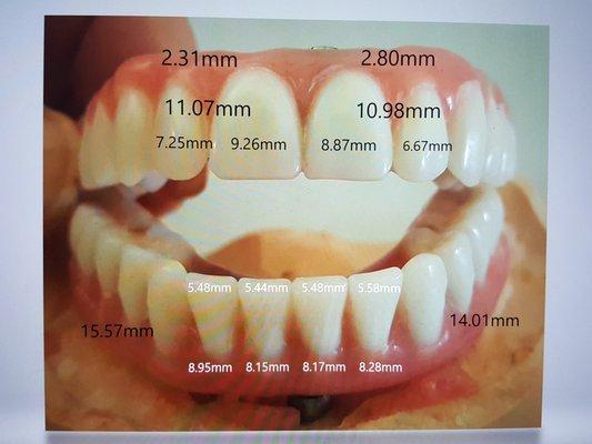 Harogiannis last temps, oversized for my mouth, unable to chew on back teeth.