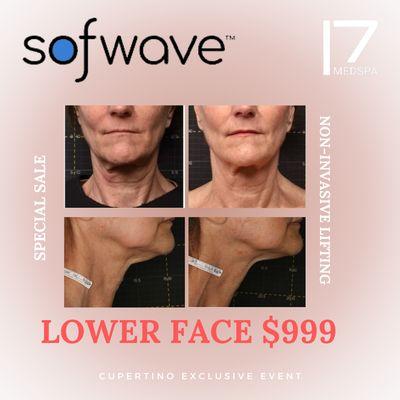 SofWave on sale now! Call us now to make a free consultation.