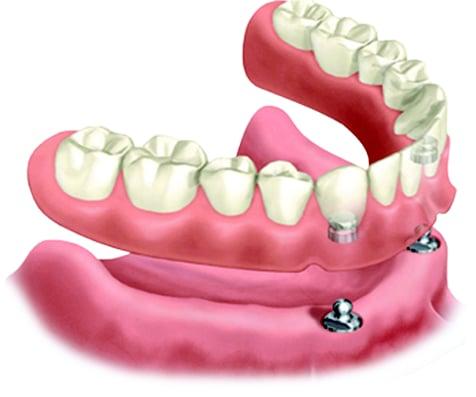 Lock in your smile with dental implants, ask us how!