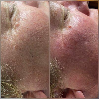 Acne Facial with deep extractions, before and after.