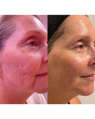 3 Advanced Plasma Treatments, 2 Age Defying Facials