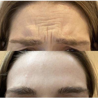 Dysport for the forehead wrinkles and "eleven" lines