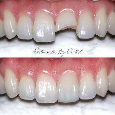 Discover how trauma can be restored to achieve natural esthetic and function in dentistry.