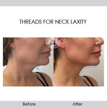 Threads for neck laxity