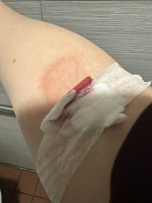 Painful blood draw and post bleeding due to incompetent staff at this Quest.