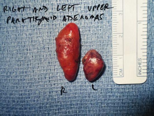 The two adenomas that were removed.